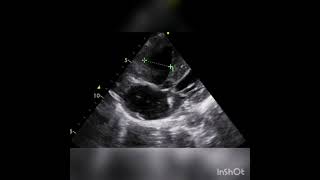 Ventricular septal defect [upl. by Rihana]