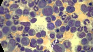 Juvenile Myelomonocytic leukemia 3 patients [upl. by Anaihsat]