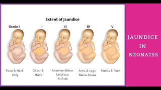 Jaundice Symptoms Types Causes amp Treatment amplemedicallectures [upl. by Asik]