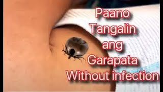 Paano Tanggalin ang Garapata sa Balat WITHOUT INFECTION  Garapata sa Bata  Garapata [upl. by Kreg175]