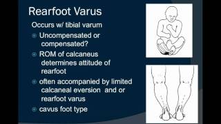 Rearfoot Varus [upl. by Gerhardt297]