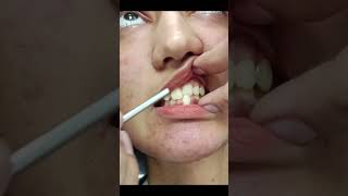 The Easy Way to Fix Cross Bite Without Surgery [upl. by Atena909]