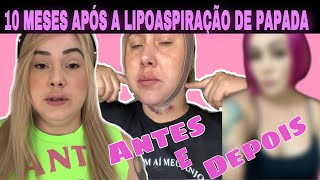 ANTES E DEPOIS DA MINHA LIPOAPIRAÇÃO DE PAPADA CIRURGICA  LIPO DE PAPADA [upl. by Bronk]