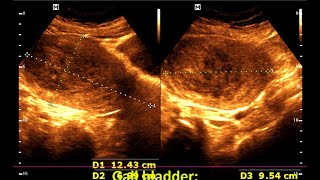 Understanding Large Intramural Fibroids Diagnosis and Management [upl. by Aicelf544]