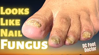 Looks Like Nail Fungus Treating and Trimming Fungal Nails [upl. by Frear]