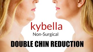 Kybella injection Double Chin Removal [upl. by Dowling596]