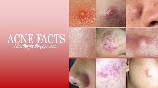 Types of Acne [upl. by Anytsirk]