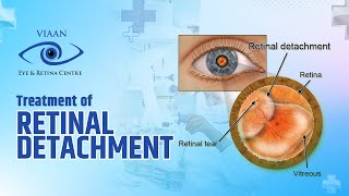 Treatment of Retinal Detachment  Dr Neeraj Sanduja  Retina Specialist  Viaan Eye amp Retina Centre [upl. by Zandra]