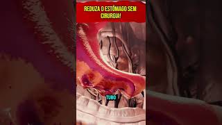 Reduza o Estômago Sem Cirurgia curiosidades fatosecuriosidades [upl. by Burman]