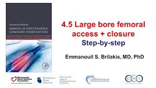 45 Large bore access with double Perclose  Manual of PCI [upl. by Muns123]