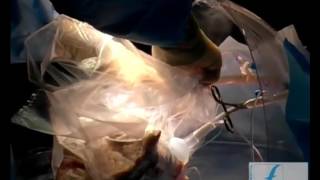 Transplantation Pulmonaire – donneurs et receveurs marginaux  SAGE E Foch Suresnes [upl. by Idelia]