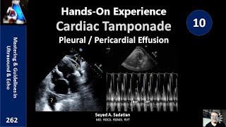 Pericardiocentesis in Pericardial Effusion and Cardiac Tamponade Animation by Cal Shipley MD [upl. by Oirom]