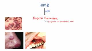 HHV8 and Kaposi Sarcoma [upl. by Ahseken]