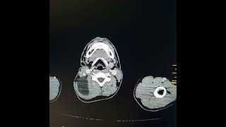 Lymphangioma along right side of neck and upper posterior thorax [upl. by Tjaden]