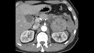 Pheochromocytoma bleeding  Life Threatening condition  Beware [upl. by Grant]