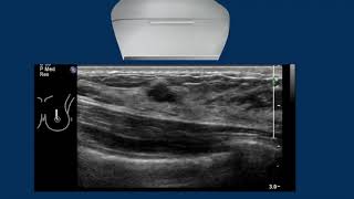 Breast Ultrasound cancer 3 [upl. by Igor]