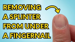 My Simple Trick to Instantly Remove a Splinter From Under Your Fingernail watch until the end [upl. by Streeter521]