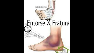 Entorse do Tornozelo com Fratura Luxação TRATAMENTO CONSERVADOR Clínica Fisioterapia Dr Robson Sitta [upl. by Yniar]