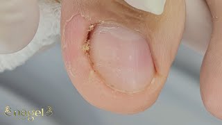 😣EU VI QUE TINHA ALGO LÁ DENTRO satisfying ingrowntoenail [upl. by Oralla]