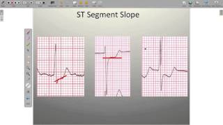 Effects of Ischemia on the ECG [upl. by Annoyt]