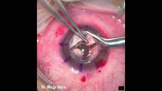 Deep Anterior Lamellar Keratoplasty DALK for Herpetic Keratitis Dr Necip Kara [upl. by Danais]