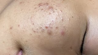 ACNE TREATMENT VU QUYNH MI Blackheads On Boy Face 2024 [upl. by Jemma]