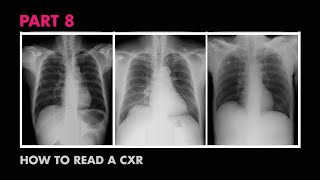 Diaphragms and Pleural Effusion  How to Read a Chest XRay Part 8  MEDZCOOL [upl. by Kerwin]