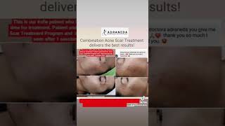 Synergistic Acne Scar Treatment  Subcision TCA CROSS RF Fractional PRP Fillers [upl. by Farmelo]