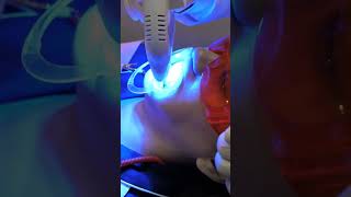 White Composite Filling a Molar  Laser filling good for teeth mandible jawbone actino [upl. by Bird]