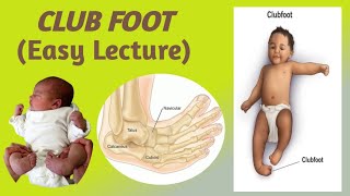 CLUB FOOTTALIPES EQUINOVARUSEpidemiology etiology risk factors classification and Management [upl. by The281]