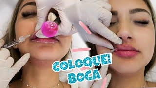 FIZ LIPO NA PAPADA E COLOQUEI PREENCHIMENTO NA BOCA  VLOG [upl. by Hgielsa998]