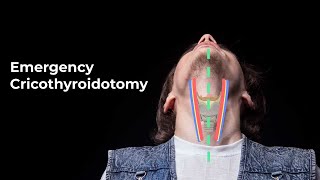 Performing an Emergent Cricothyroidotomy  MEDZCOOL [upl. by Moersch]