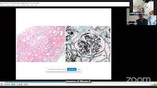 TMAThrombotic Microangiopathy in Renal Allograft Dr Pallav Gupta Lec 7 [upl. by Aicnetroh638]