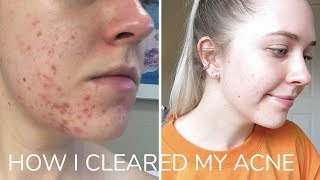 How I Cleared My Acne [upl. by Hoxsie]