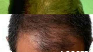 PRP Hair Loss Treatment Bangladesh [upl. by Eihtak]