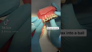 How to use orthodontic wax [upl. by Nadaha456]