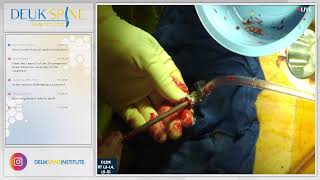 Endoscopic Debridement of Spinal Infection w Fusion  L3L4 L5S1 [upl. by Vincentia474]