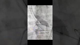 Balloon Aortic Valvuloplasty BAV procedure and details [upl. by Dnalel957]