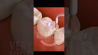 What is a Dental Sealant sealant sealants cavities nocavities dentist dentistry [upl. by Milewski518]