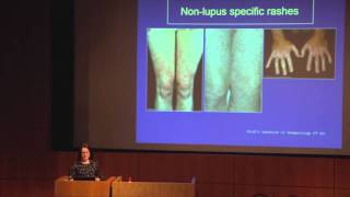 Lupus The Skin amp Hair  Dr Abby Macbeth East Anglia Lupus Info Day Oct 2013 [upl. by Nesiaj42]