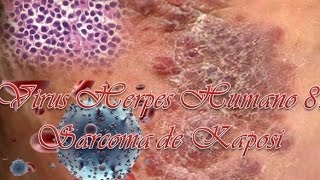 Virus Herpes Humano 8Sarcoma de Kaposi [upl. by Annaierb]