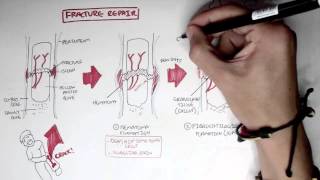 Repair of broken bone  Hematoma  Callus  Class 12 Biology [upl. by Maxy]