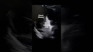 Collapsed lung in large pleural effusion radiology ultrasound usg science [upl. by Nalyak455]