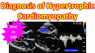 Diagnosis of Hypertrophic Cardiomyopathy [upl. by Barbara]