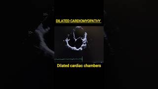 Dilated Cardiomyopathycardiomyopathymyocarditisechoheartfailure heartfunctionpericarditis [upl. by Eimak860]