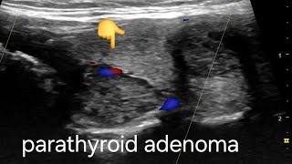 Large Parathyroid adenoma ultrasound and color Doppler video [upl. by Atnamas]