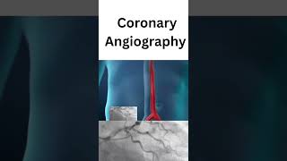 Coronary angiography  treatment of coronary heart disease [upl. by Oskar]