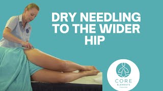 Dry Needling to the wider Hip focusing on the Abductors [upl. by Still263]