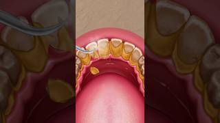 Removing Tonsil Stones And Dental Tartar sorts cartoon viralsong makeup animationvideo [upl. by Kemeny795]