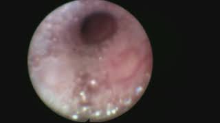 Tracheomalacia Surgical management Aortopexy and posterior Tracheopexy [upl. by Ayalat]